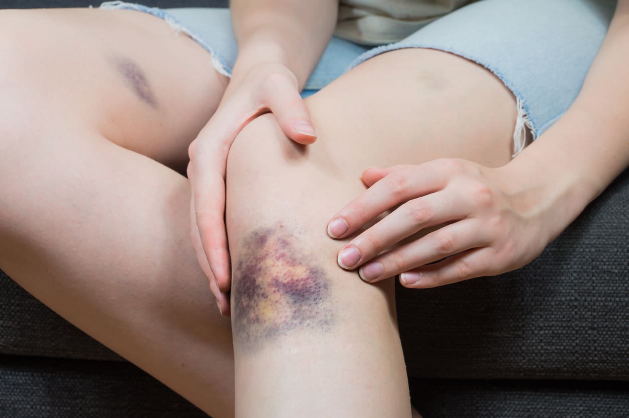 Junge Frau mit grossem Hämatom am Knie und kleinerem Bluterguss am Oberschenkel